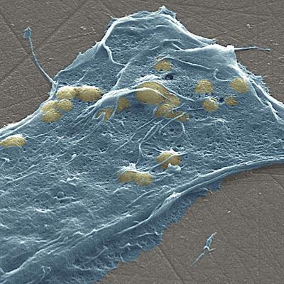 Cover image for research topic "Lipid Alterations in Cancer Development, Resistance and Recurrence"