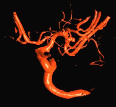 Cover image for research topic "Neuroinflammation as a Target for Intervention in Subarachnoid Hemorrhage"
