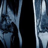 Cover image for research topic "Advances in Clinical Sarcoma Research: Quality of Life in Sarcoma Patients"