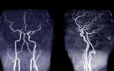 Cover image for research topic "Advancing Precision Medicine in Acute Stroke Care: Personalized Treatment Strategies and Outcomes"