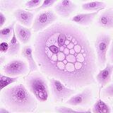 Cover image for research topic "HPV infection and cervical, vagina, and vulvar cancers"