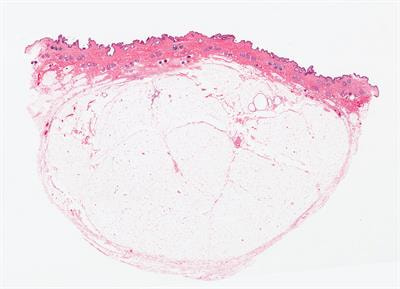 Cover image for research topic "The Impact of Lipid Metabolism on Cancer Progression and Metastasis"