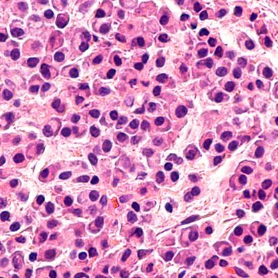 Cover image for research topic "Transplantation and Cellular Therapy in Lymphomas and Plasma Cell Disorders"