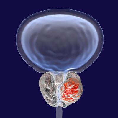 Cover image for research topic "Metastatic Hormone-Sensitive Prostate Cancer: New Therapeutic Strategies to Improve Patient Outcome"