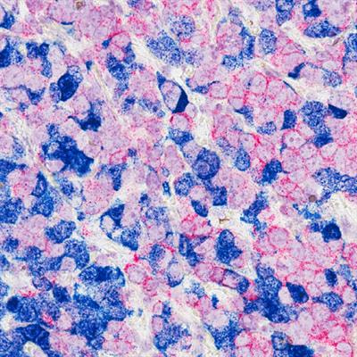 Cover image for research topic "The Exciting Opportunities and Challenges for Targeting “HER2 low” Breast Cancers and Beyond"