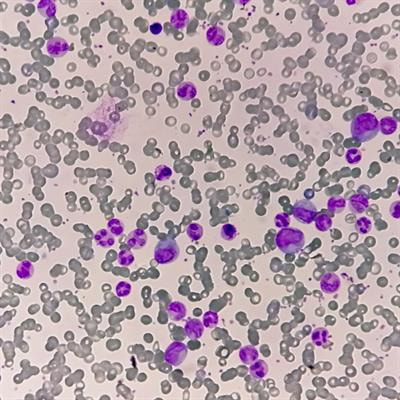 Cover image for research topic "Current Challenges in Hematology: The Biological and Therapeutic Advances in Chronic Myeloid Leukemia"