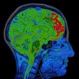Cover image for research topic "Speech-Language Neurophysiology and Intervention: Neural Markers, Predictors, and Correlates of Treatment Response"