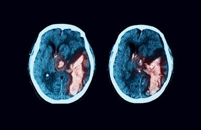 Cover image for research topic "Omics-Based Approaches in Stroke Research"