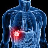 Cover image for research topic "Liver Cancer Awareness Month 2023: Current Progress and Future Prospects on Advances in Primary Liver Cancer Investigation and Treatment"