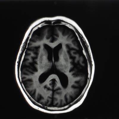 Cover image for research topic "Decompressive Craniectomy and Cranioplasty: Challenges and Chances Volume II"