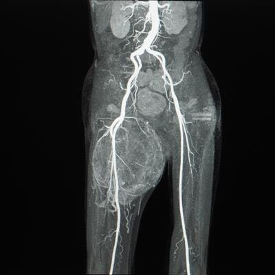 Cover image for research topic "Comprehensive Treatment Strategy for Improving Surgical Resection Rate of Retroperitoneal Sarcomas"