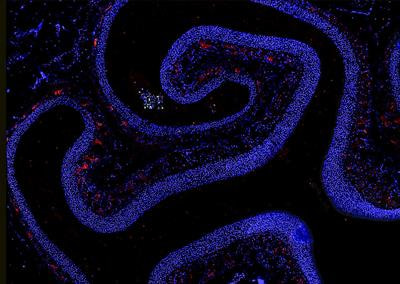 Cover image for research topic "Advances in Understanding the Pathogenesis of Chronic Rhinosinusitis"