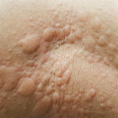Cover image for research topic "Urticaria and Mimickers of Urticaria"