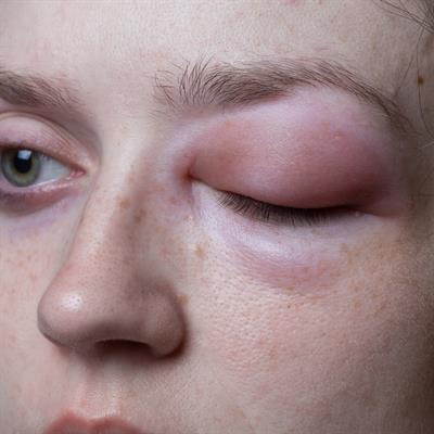 Cover image for research topic "Bradykinin and Histamine Mediated Angioedema"