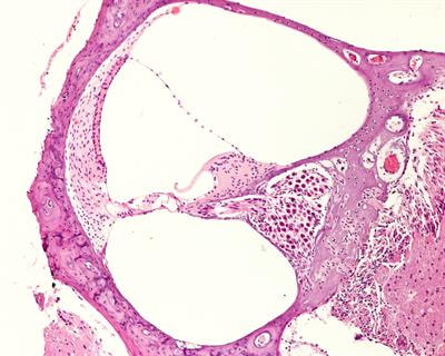 Cover image for research topic "Meniere’s Disease: From Diagnosis to Treatment"