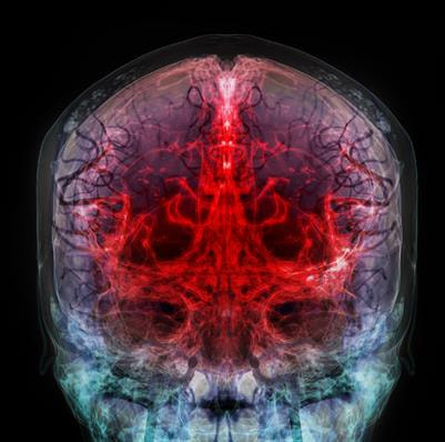 Cover image for research topic "Cryptogenic Ischemic Stroke"
