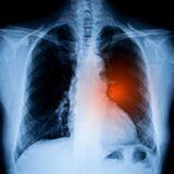 Cover image for research topic "EGFR-TKIs for Lung Cancer Treatment: Development, Application, and Side Effects"