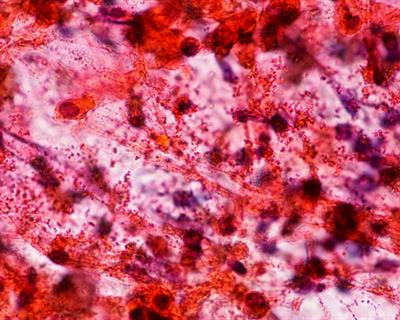 Cover image for research topic "Severe Eosinophilic Disorders: Mechanisms and Clinical Management"