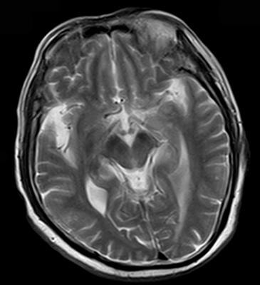 Cover image for research topic "Forms of Degeneration and Dysregulation in the Central Nervous System"