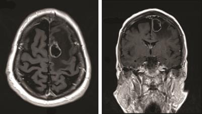 Cover image for research topic "Contemporary Management of Intracranial Metastatic Disease"