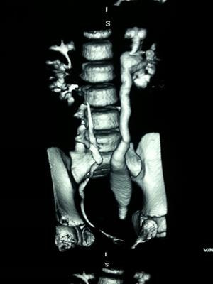 Cover image for research topic "Management of Primary Obstructive Megaureter"