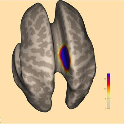 Cover image for research topic "Source Imaging in Drug Resistant Epilepsy - Current Evidence and Practice"