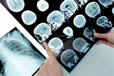 Cover image for research topic "The Role of Modern Neuro-oncology in the Treatment of Primary CNS Tumors and Brain and Spinal Metastases"