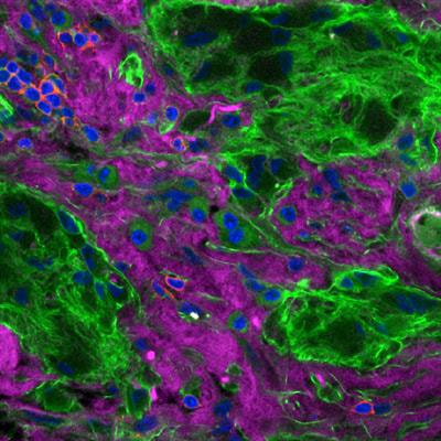 Cover image for research topic "Immune Responses in Nervous System Tumors"