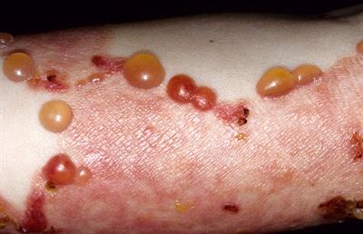 Cover image for research topic "Skin Autoimmunity"