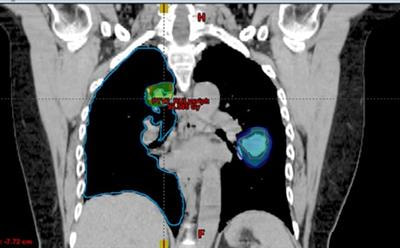 Cover image for research topic "Role of SRS/SBRT in Oligometastatic Disease"
