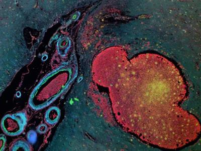 Cover image for research topic "Cerebral Small Vessel Diseases: From Vessel Alterations to Cortical Parenchymal Injury"