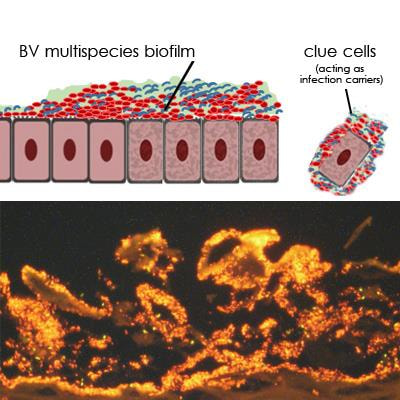 Cover image for research topic "Bacterial Vaginosis, a Model of True Polymicrobial Infections: Genetics, Evolution, Clinical and Socio-Clinical Implications"