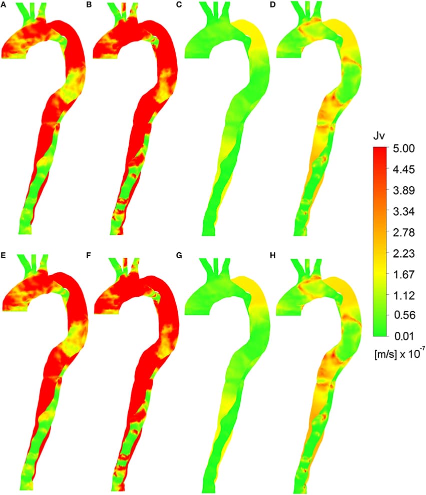 Volume flux (Jv, lj) calculated using various parameters. Wall shear indices (A) TAWSS, (B) HOLMES with constant plasma viscosity and uniform pressure gradient. Wall shear indices (C) TAWSS, (D) HOLMES with non-Newtonian blood viscosity and uniform pressure gradient. (E) TAWSS, (F) HOLMES with constant plasma viscosity and time averaged pressure gradient. (G) TAWSS, (H) HOLMES with non-Newtonian blood viscosity, and time-averaged pressure gradient.