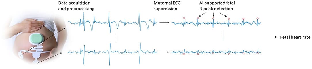 Schematic illustration of the data acquisition and signal processing steps that are used to obtain FHR.