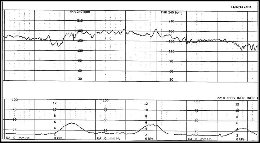 Example of FHR (top) and uterine contraction (bottom) during labor, captured simultaneously and stored electronically in a digital format but available only as a rasterized pdf document.