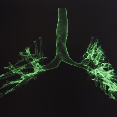 Cover image for research topic "Pulmonary Fibrosis: one manifestation, various diseases"