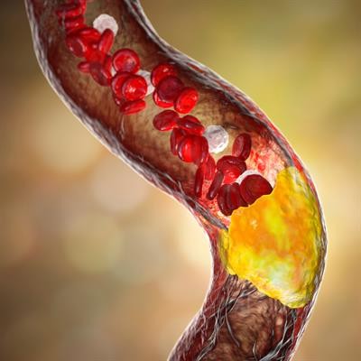 Cover image for research topic "Case Reports in Atherosclerosis and Vascular Medicine: 2022"