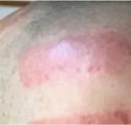 5g Skin Rash Frontiers | Prevention and Management of Dermatologic Adverse Events ...