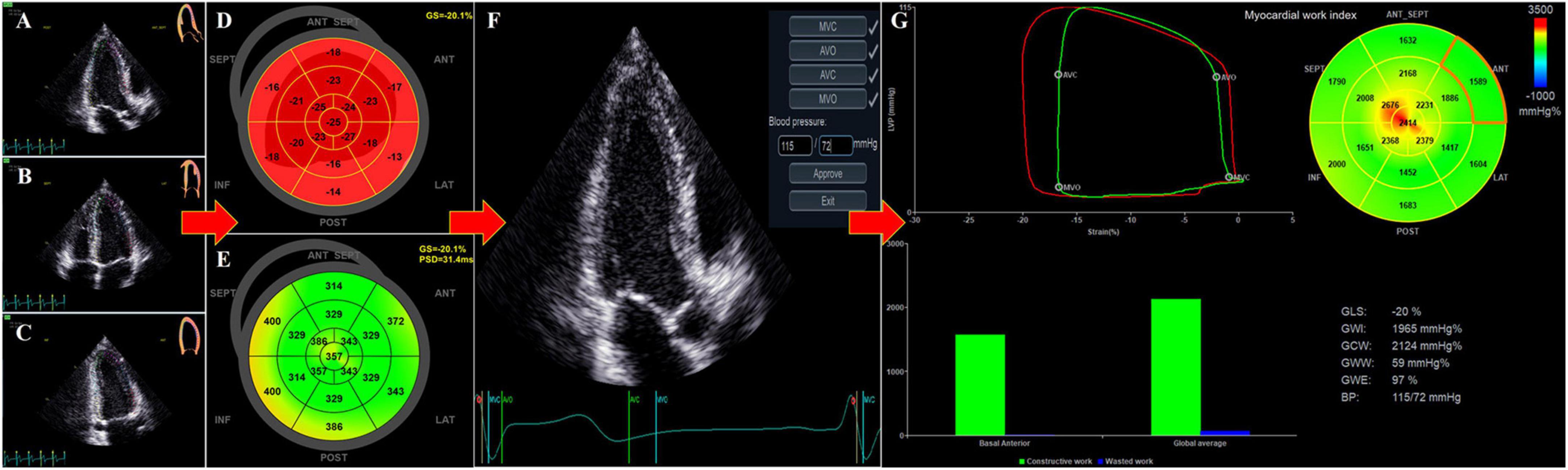 2- and 3-Dimensional Myocardial Strain in Cardiac Health and