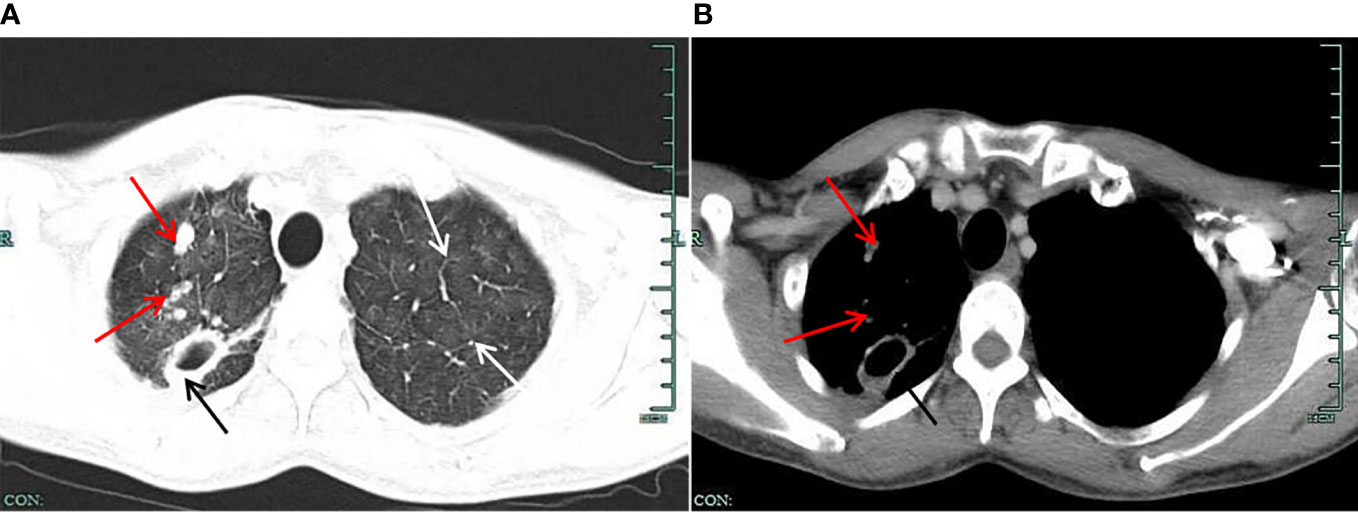Frontiers Case report Application of morphology in the diagnosis of