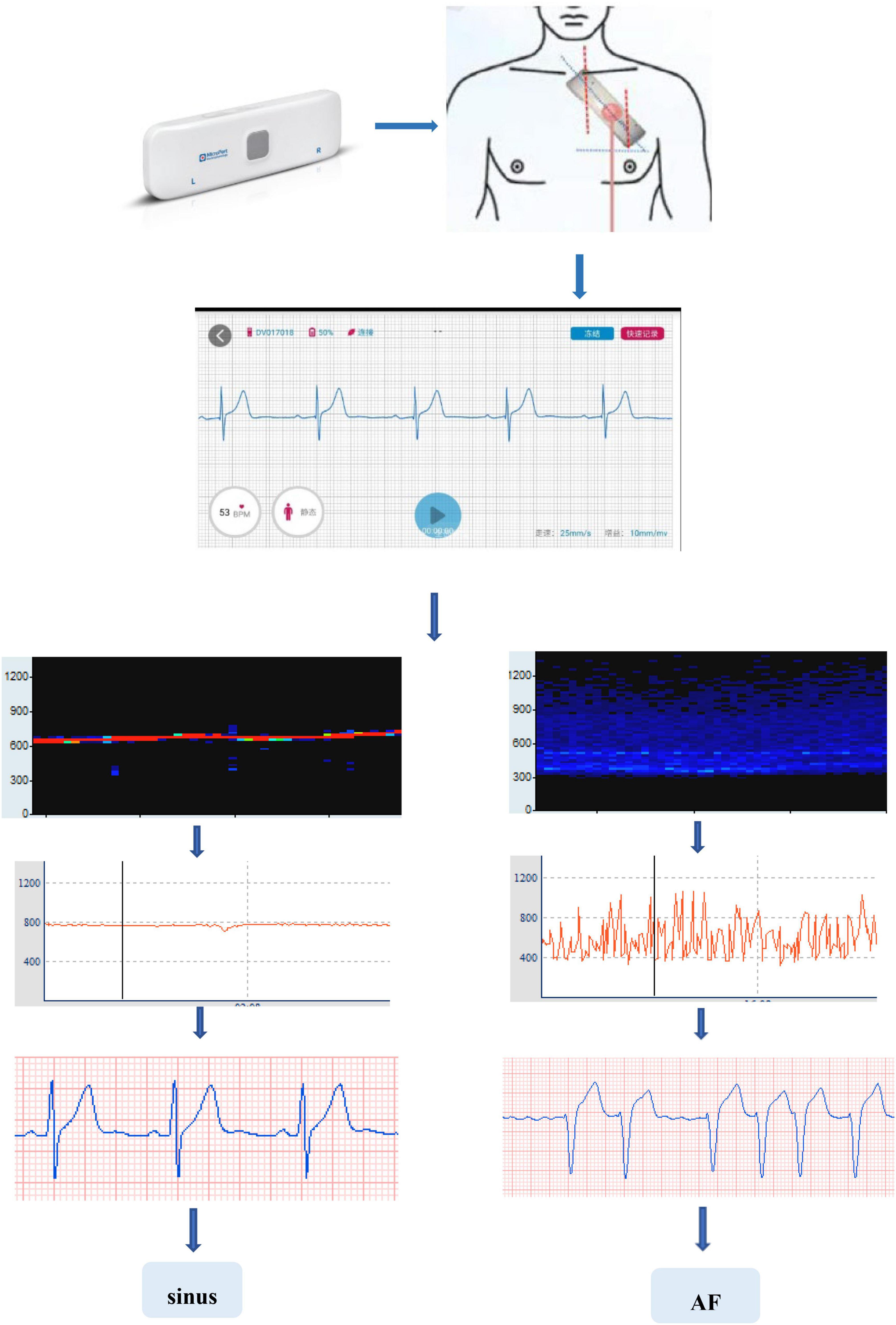 AI Accurately Detects LV Dysfunction Using Single-Lead Apple Watch ECG