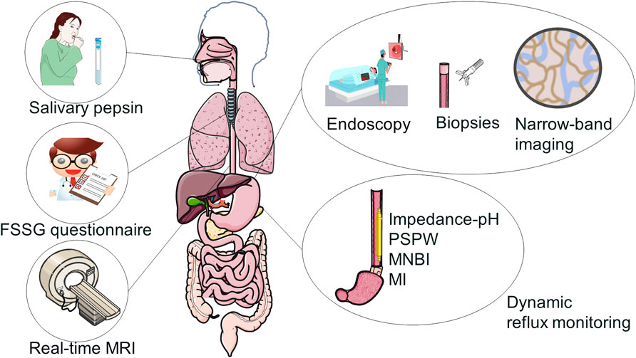 Frontiers  GERD-related chronic cough: Possible mechanism, diagnosis and  treatment