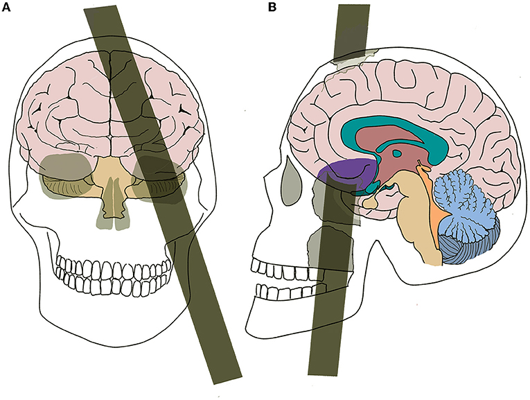 Figure 1 - (A) A face view of how Phineas Gage’s metal tamping pole passed through his cheek and out the top of his head.
