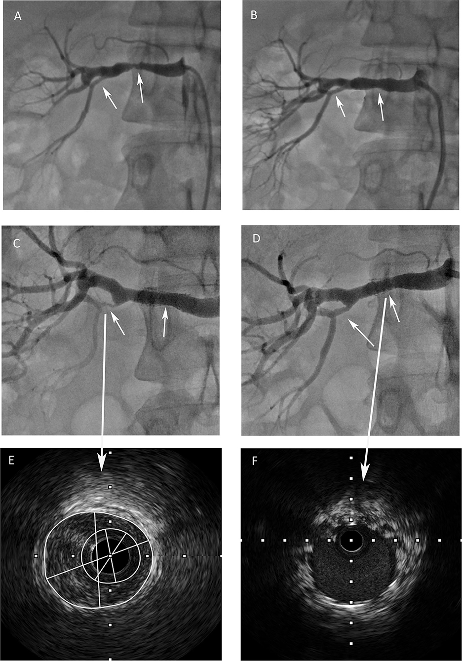 Rajini Sharma Sex Video - Frontiers | Case report: Recurrence of hypertension after renal artery  angioplasty due to the progression of focal renal fibromuscular dysplasia