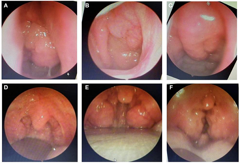 tonsillar hypertrophy score