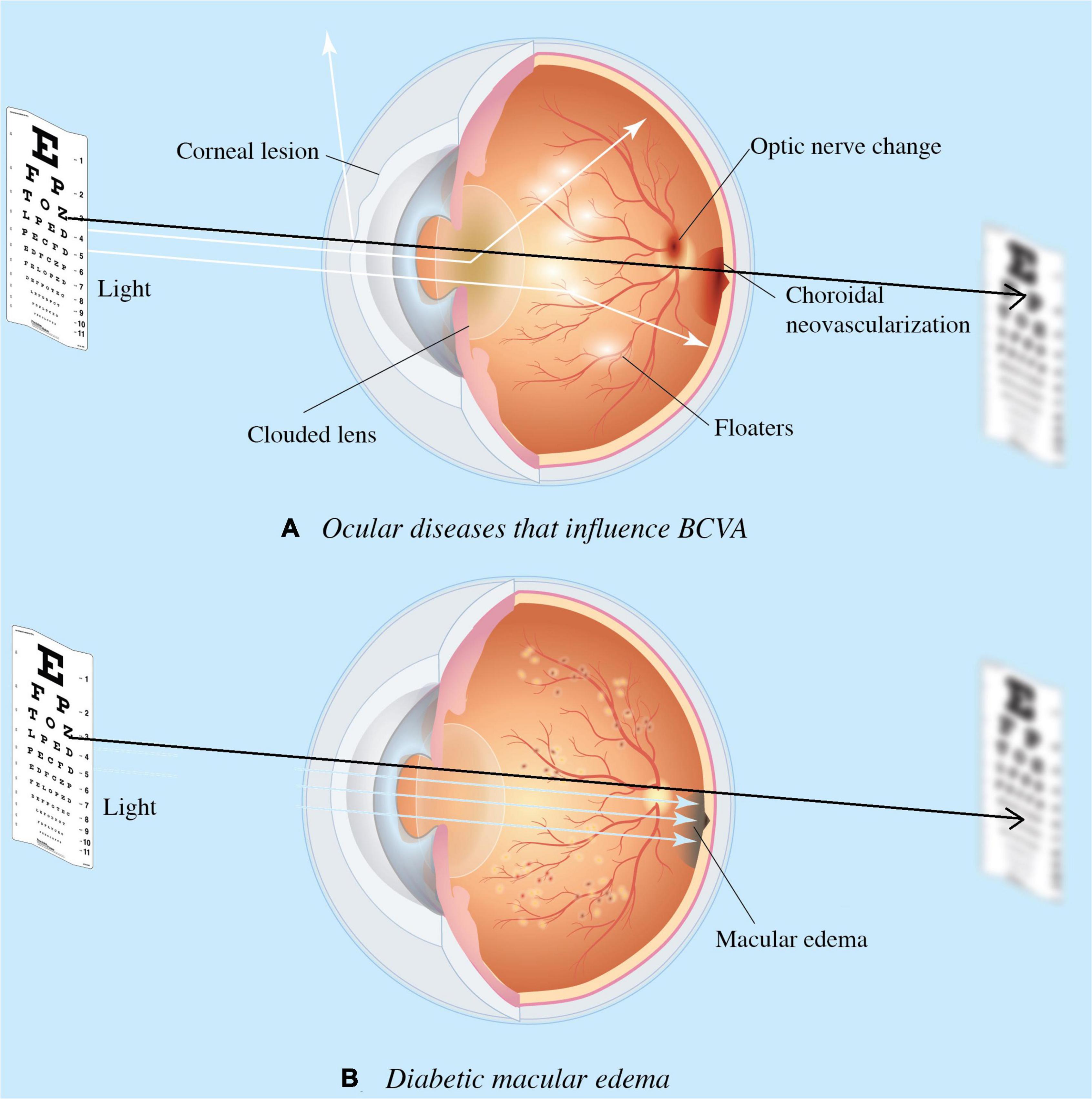 research articles on diabetic macular edema