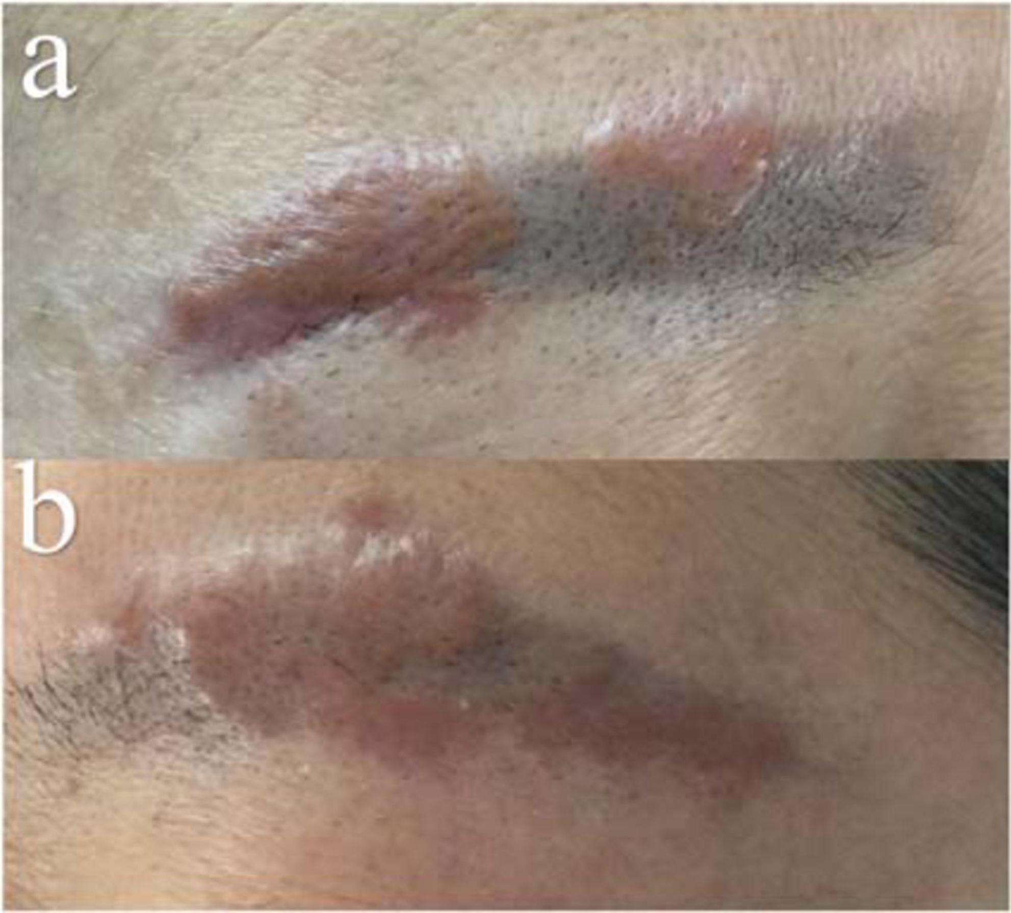 Papulonodular tattoo lesions as a clinical sign of systemic sarcoidosis   SpringerLink