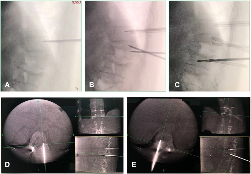 Frontiers | Percutaneous vertebral-disc plasty for thoracolumbar very ...
