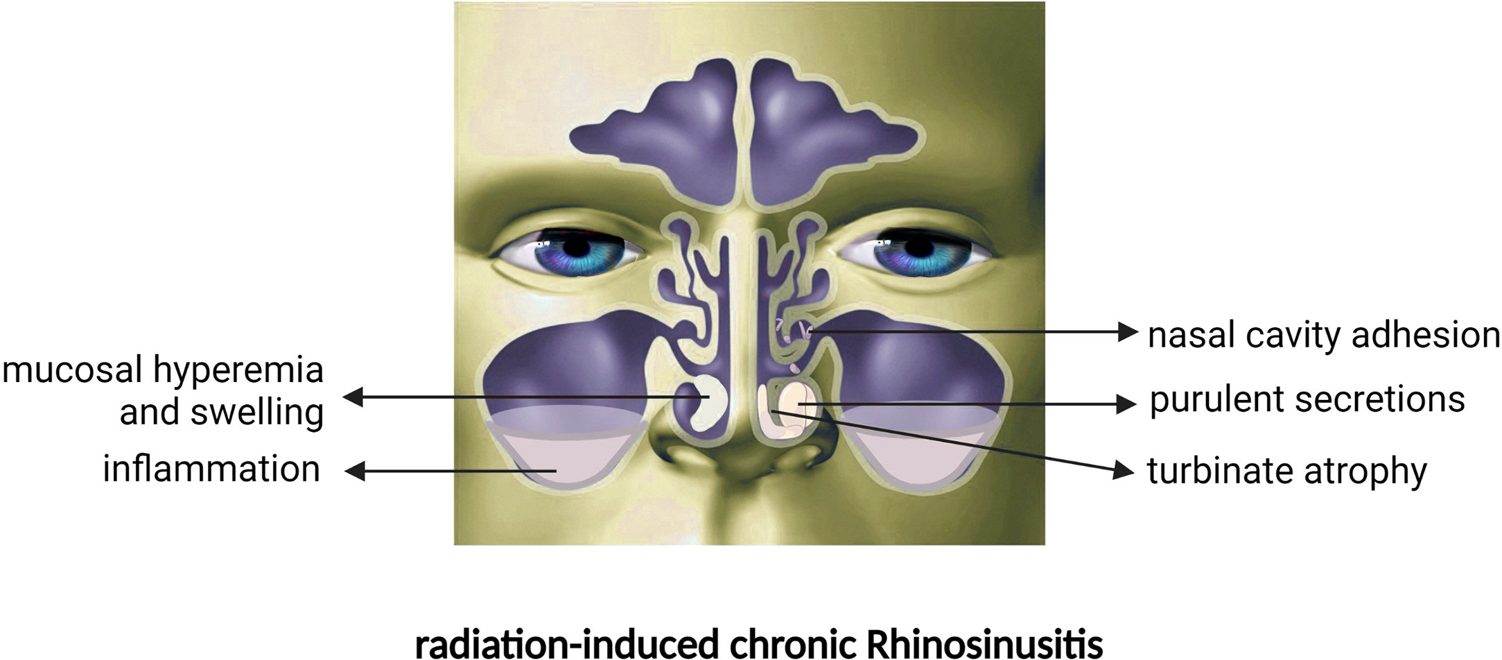 purulent nasal drainage