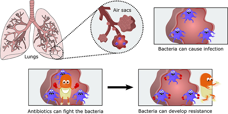 Figure 1 - Bacteria can cause infections all over the body, but in this figure bacteria are multiplying inside the lungs.
